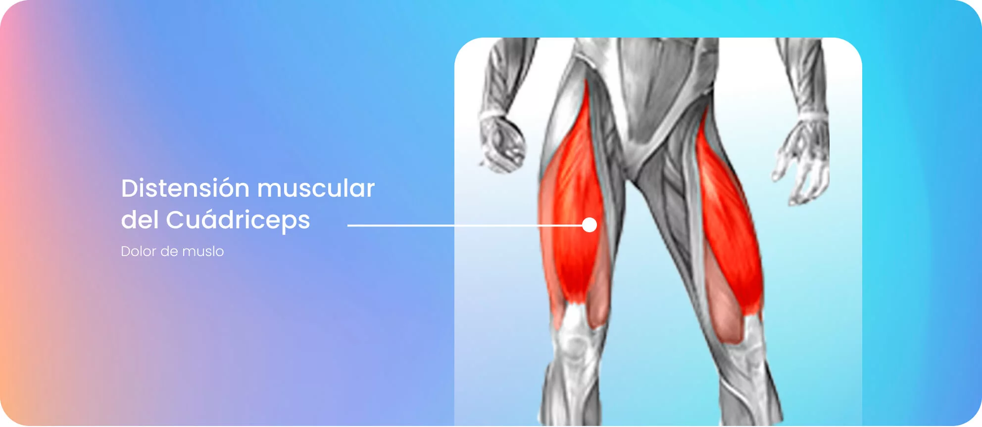 Distensión muscular del cuádriceps